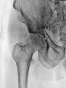 an X-ray showing a fractured hip bone