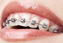What To Avoid When Wearing Braces?