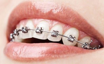 What To Avoid When Wearing Braces?