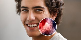 When Is It Necessary to Remove Wisdom Teeth?