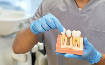 A Comprehensive Guide to Dental Implants in Dallas
