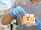 A Comprehensive Guide to Dental Implants in Dallas