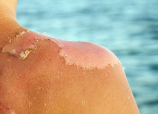 Learn The Correct Way on How to Treat Sun Poisoning how to treat sun poisoning