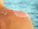 Learn The Correct Way on How to Treat Sun Poisoning how to treat sun poisoning