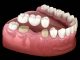 Differences Between Temporary and Permanent Dental Crowns